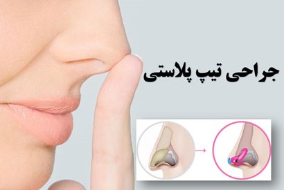 تیپ پلاستی روشی برای کوچکتر کردن بینی