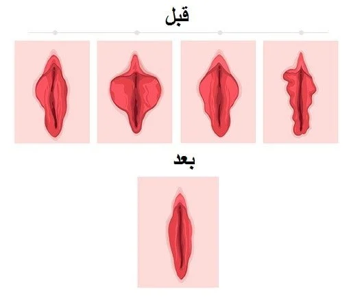 شیراز لابیاپلاستی قبل و بعد